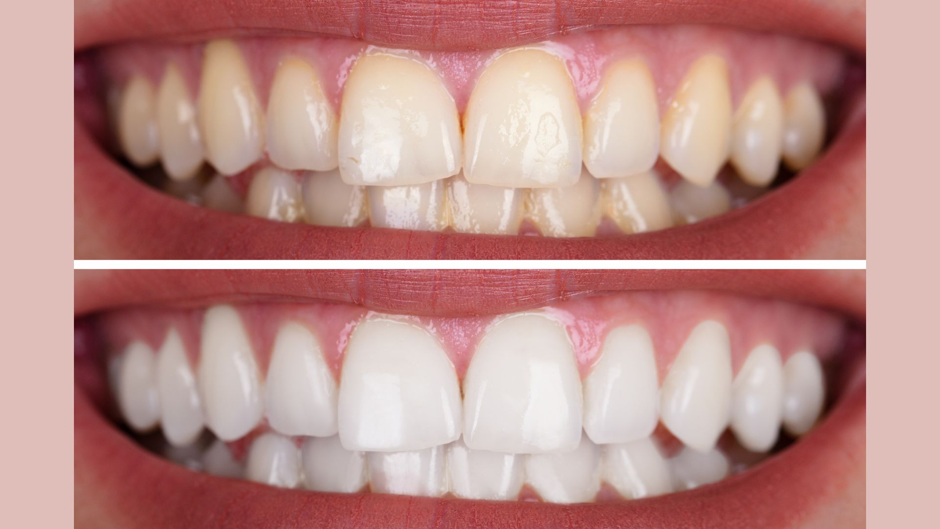 Clinical teeth whitening result at The Esthetic Zone, Dar es Salaam