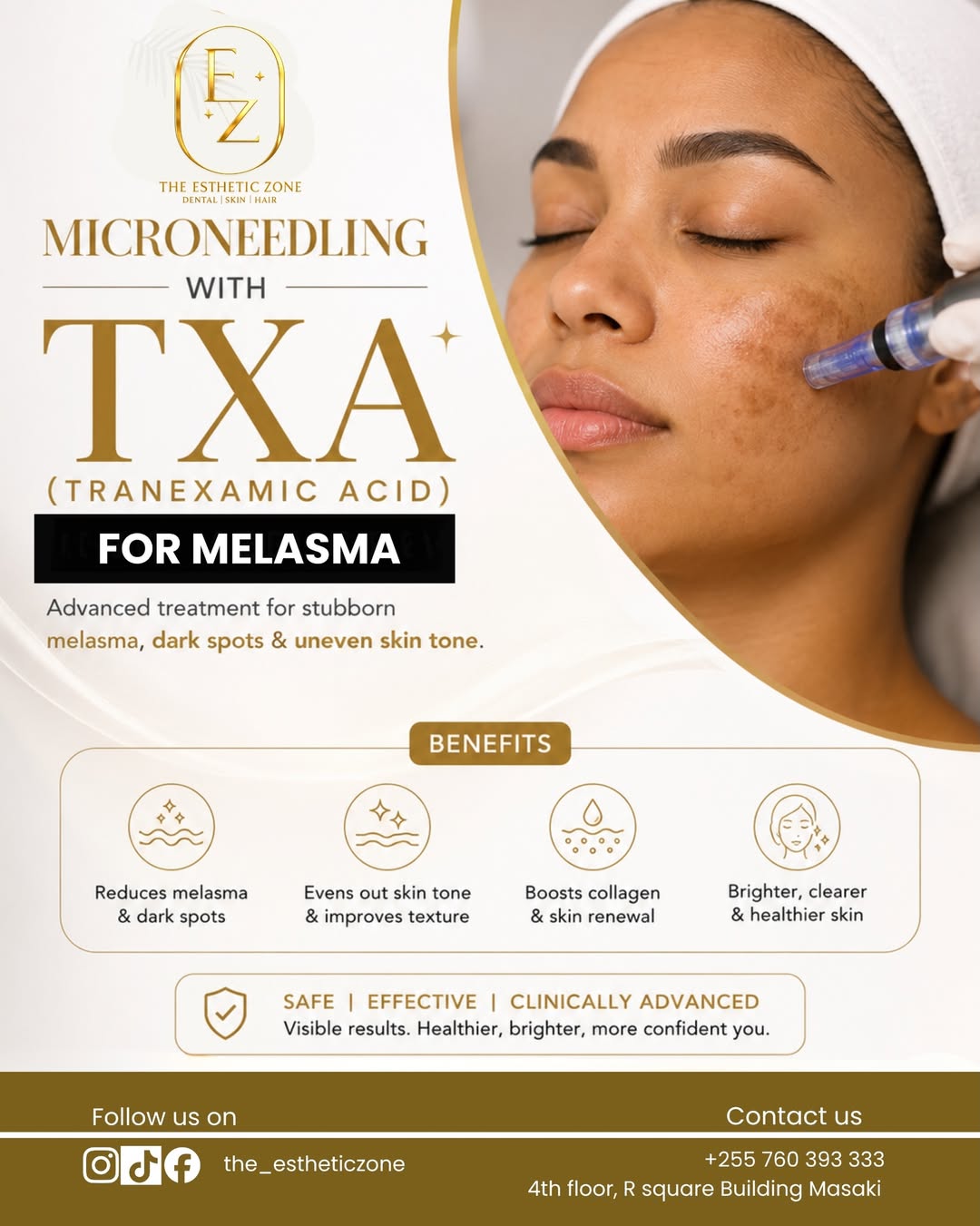 Microneedling with TXA for Melasma & Dark Spots | The Esthetic Zone